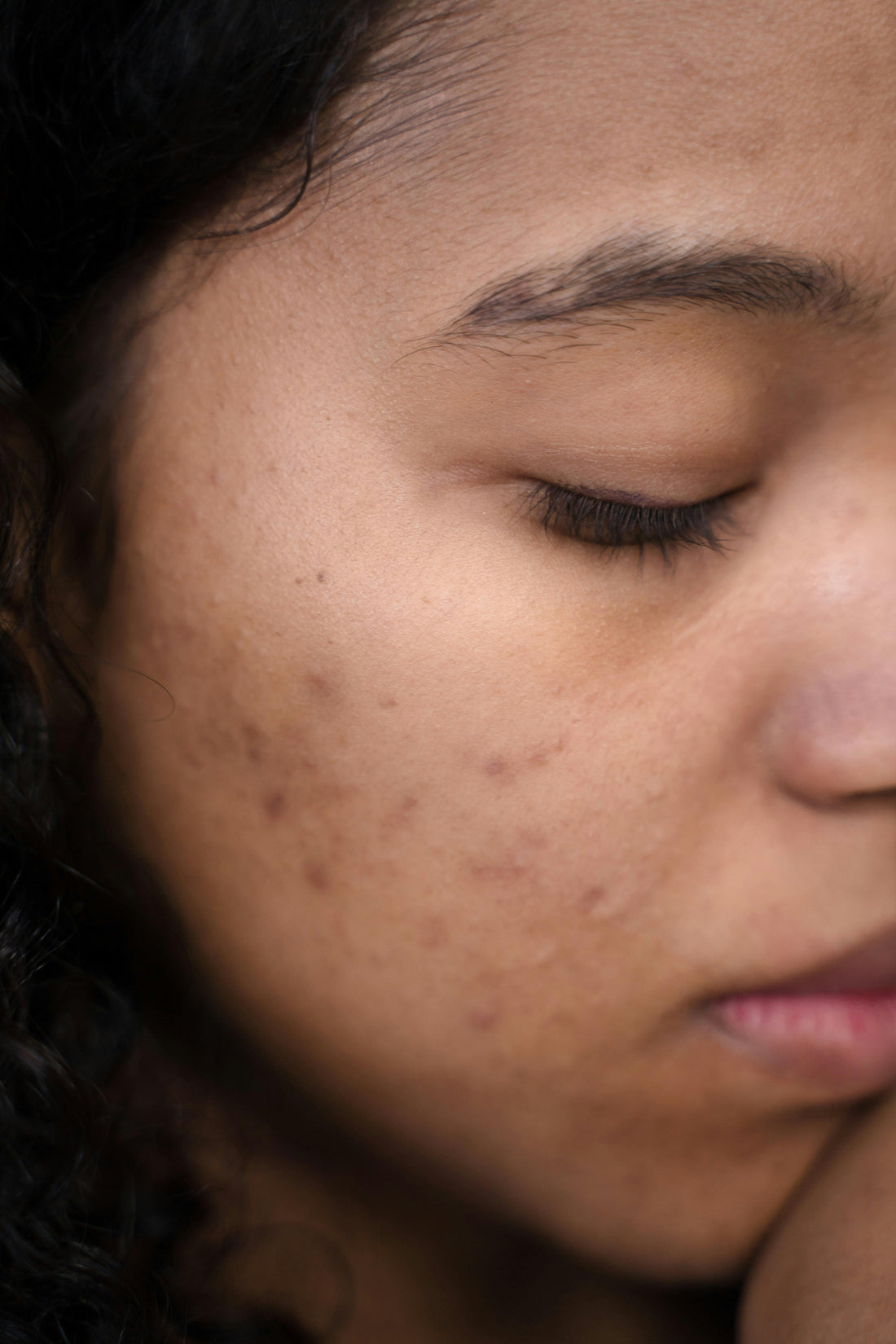 Espinhas no queixo e mandíbula: entenda o que é a acne hormonal e como ela sinaliza SOP - Ovacare